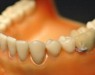 Учёные разработали Bluetooth-зуб, который следит за состоянием полости рта